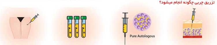 تزریق چربی باسن