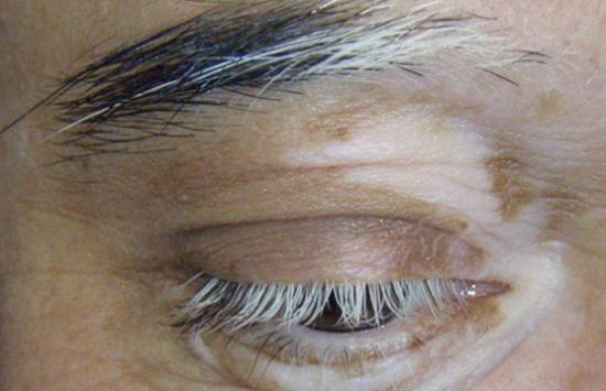 سفید شدن تکه ای مو یا همان خال مو (Poliosis)