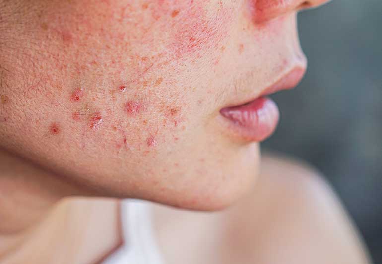 علائم سطوح بالای استروژن ، رابطه سطوح استروژن و آکنه و نکاتی برای آکنه ناشی از هورمون ها