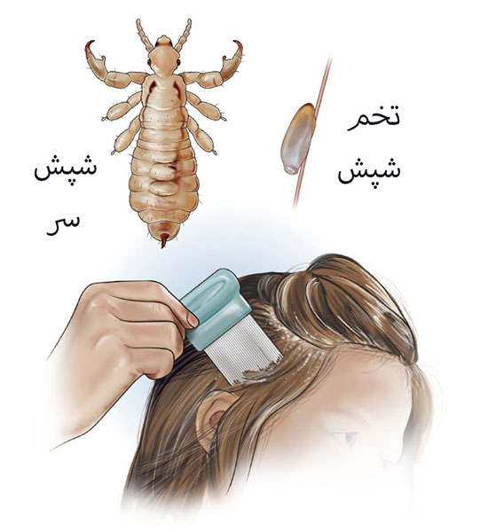 چرخه زندگی شپش سر، طول عمر شپش سر، علائم و درمان شپش سر