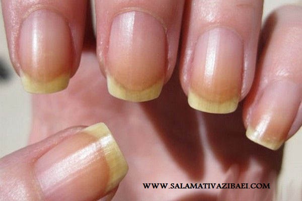 علل ایجاد خطوط عمودی روی ناخن‌ها و راهکارهای درمانی