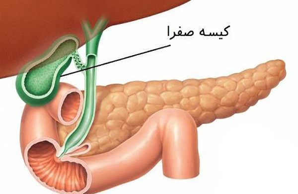 رژیم غذایی کیسه صفرا چیست؟ غذاهای مفید و مضر کیسه صفرا و غذاهای بعد از جراحی کیسه صفرا کدامند؟ 