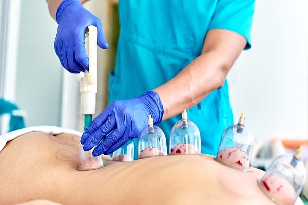 فواید و عوارض حجامت درمانی چیست؟ انواع حجامت و نحوه انجام حجامت درمانی