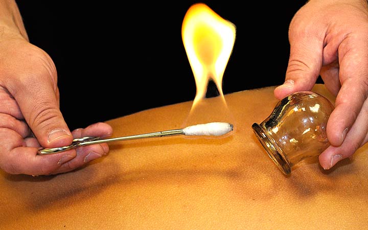 فواید و عوارض حجامت درمانی چیست؟ انواع حجامت و نحوه انجام حجامت درمانی