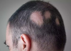 علائم آلوپسی اسکار چیست؟ علل، عوارض و درمان آلوپسی اسکار