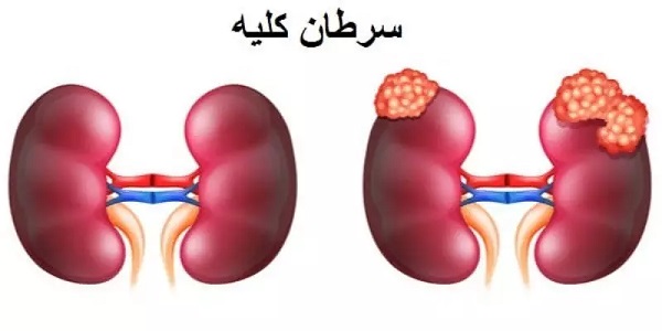 دلایل درد کلیه و حس آن،  درد کلیه در دوران بارداری و سنگ کلیه و هیدرونفروز چیست؟