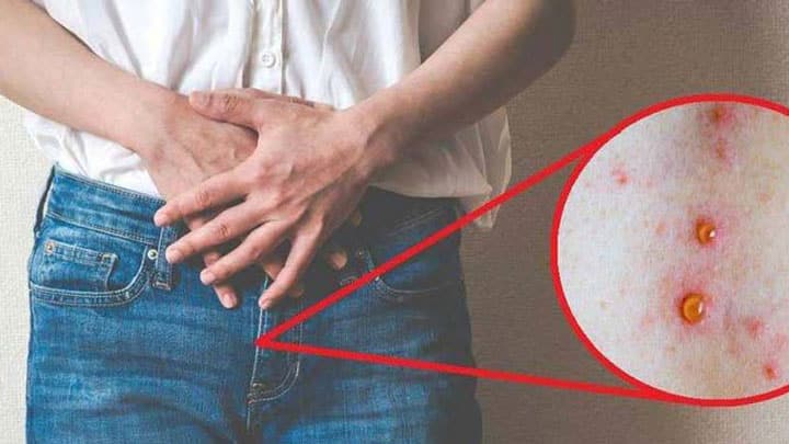 سیفلیس و ریزش مو، علائم و درمان ریزش مو سیفلیس چیست؟ 